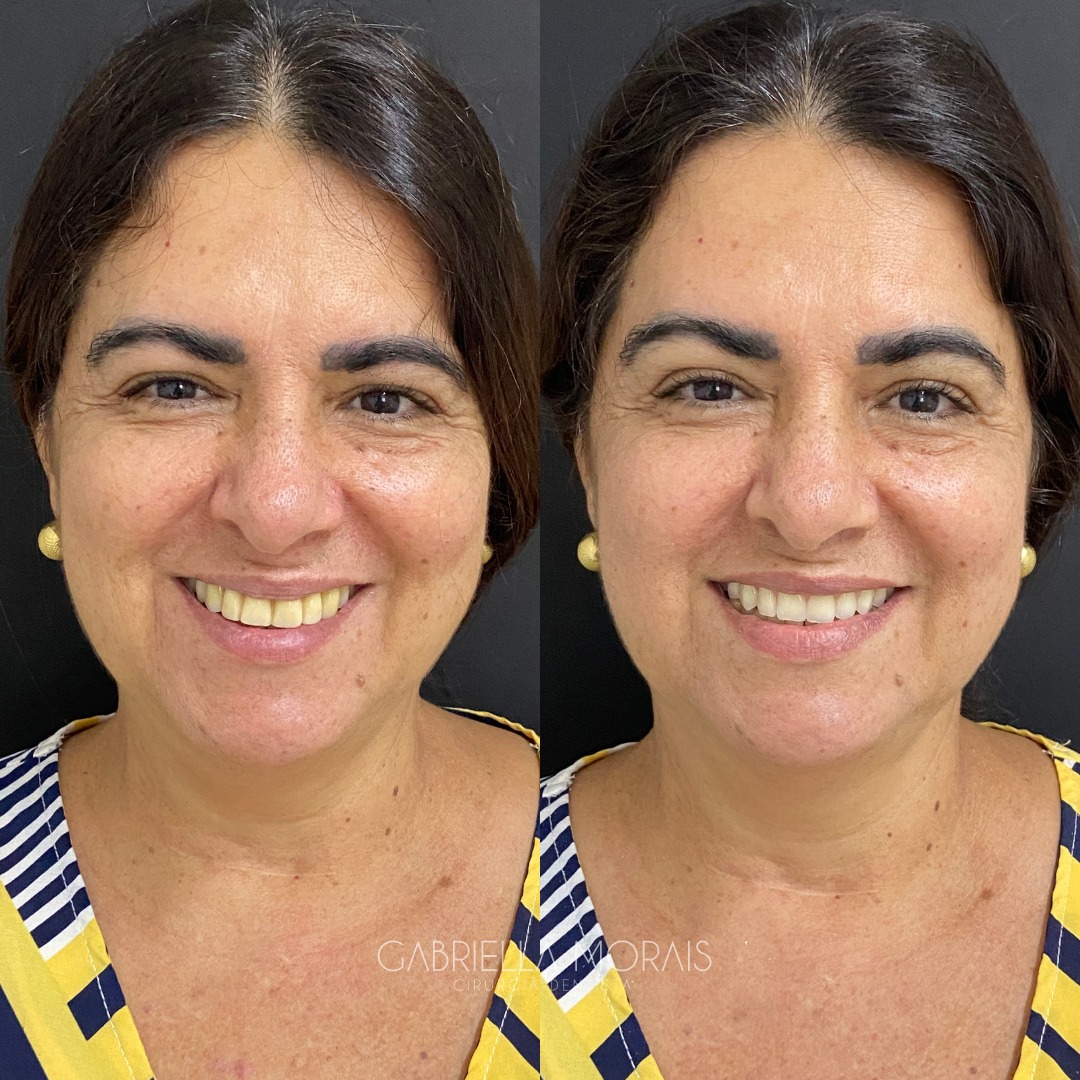 Caso 12 - Antes e Depois